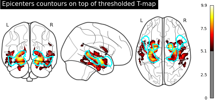 _images/sphx_glr_plot_adni_atrophy_epicenters_002.png